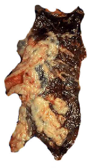 Lung cancer from smoking.